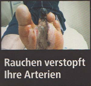 Rauchen verstopft Ihre Arterien