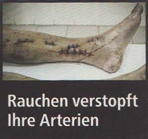 Rauchen verstopft Ihre Arterien