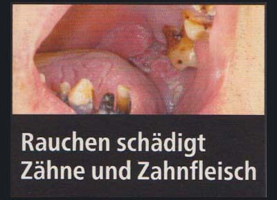 Rauchen schädigt Zähne und Zahnfleisch